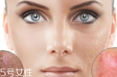 痘印多久能自行消失？多數(shù)人一年內(nèi)消失