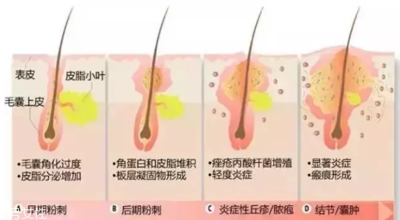 封閉性粉刺的發(fā)病機制是什么？角質層太厚