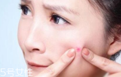 肌膚需要排毒嗎？長(zhǎng)痘并不代表排毒