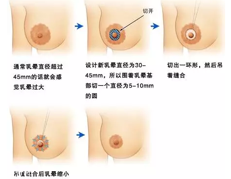 乳暈縮小術(shù)怎么做？乳暈縮小術(shù)知識(shí)全解