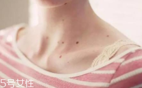 色素痣是腫瘤嗎？良性腫瘤不必擔心