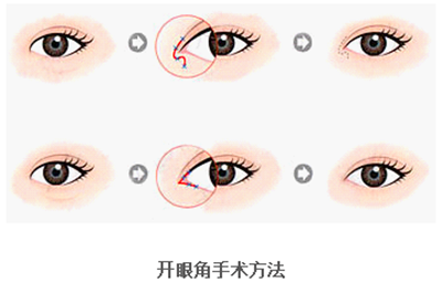 開(kāi)眼角疤痕多久消失？開(kāi)眼角的適宜人群