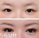 開(kāi)眼角疤痕多久消失？開(kāi)眼角的適宜人群