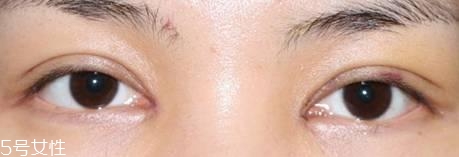 怎么縮短開(kāi)眼角疤痕消失時(shí)間？雙眼皮開(kāi)眼角恢復(fù)過(guò)程