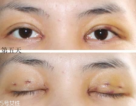 怎么縮短開(kāi)眼角疤痕消失時(shí)間？雙眼皮開(kāi)眼角恢復(fù)過(guò)程