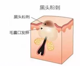 閉口是怎么引起的？4種情況要注意