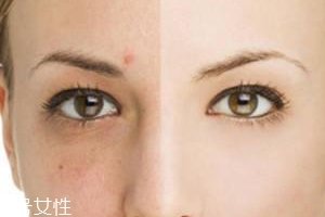 祛痘產(chǎn)品怎么選？先要分清痘印類型
