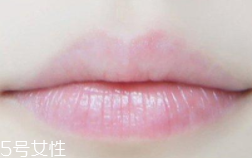嘴唇干裂是一種病嗎？治療口角炎從改善習(xí)慣入手