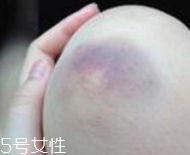 身體淤青怎么來的？不是磕碰那么簡單