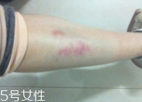 身體淤青怎么來的？不是磕碰那么簡單