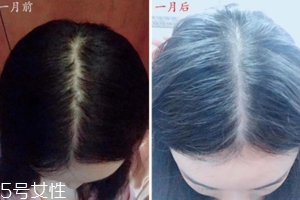 柳屋生發(fā)水有用嗎？一個(gè)月后長(zhǎng)出新發(fā)