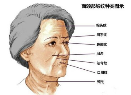 川字紋可以打玻尿酸嗎？不是最佳選擇