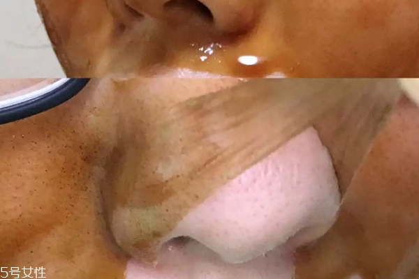 雪花秀撕拉面膜怎么撕出黑頭？這么做才能去黑頭