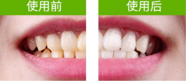 牙貼怎么分上下牙貼？牙貼怎么分正反