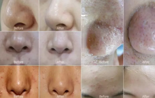 弄完小氣泡多久可以化妝？小氣泡注意事項(xiàng)