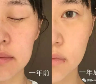 童顏機有用嗎？童顏機的功效