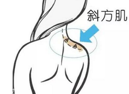 瘦肩針間隔多久打一次？打瘦肩針間隔時(shí)間