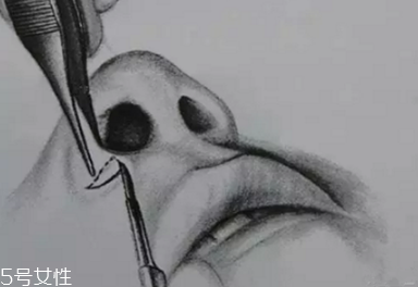 鼻翼外切多久消腫？鼻翼外切消腫時(shí)間要多長(zhǎng)？