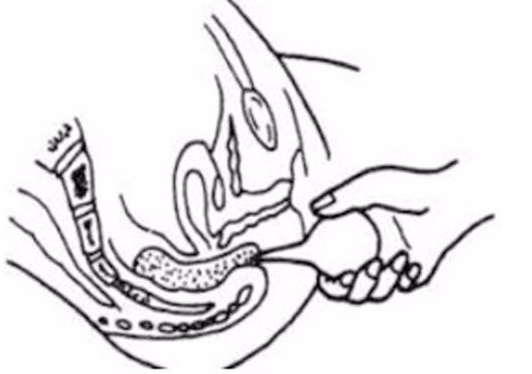 開(kāi)塞露躺著還是蹲著用？開(kāi)塞露使用姿勢(shì)