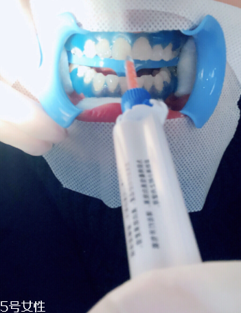 冷光美白會反彈嗎？冷光美白心得