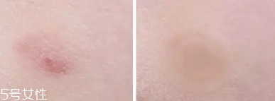 vt痘痘貼怎么用？vt老虎痘痘貼防水嗎