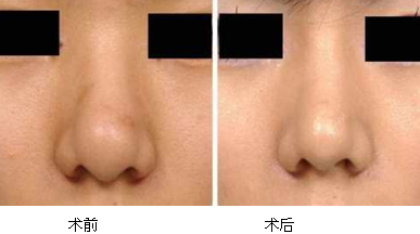 縮鼻手術(shù)多久恢復(fù)？縮鼻手術(shù)傷口才會(huì)好