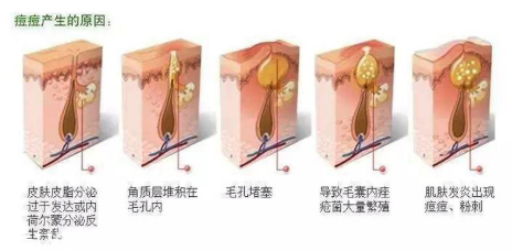 頑固痘痘怎么消除？油皮為什么反復(fù)爆痘？