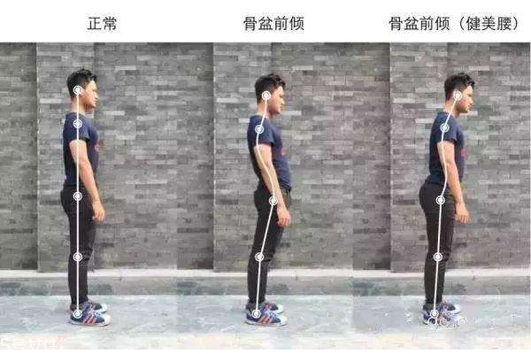 骨盆前傾怎么判斷 這個(gè)簡單方法看出假翹臀