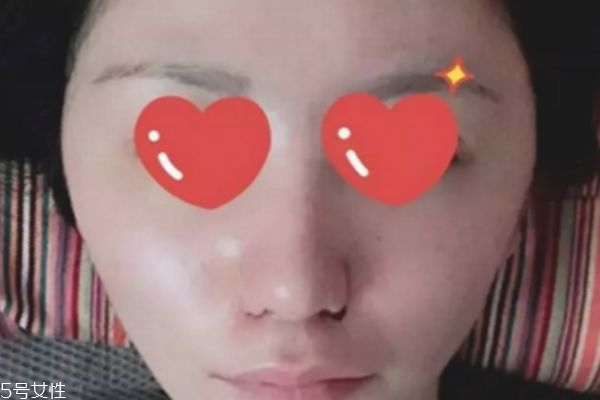 鼻翼內(nèi)切是切鼻基底嗎 鼻翼內(nèi)切效果圖 鼻翼內(nèi)切是切鼻基底嗎 鼻翼內(nèi)切效果圖