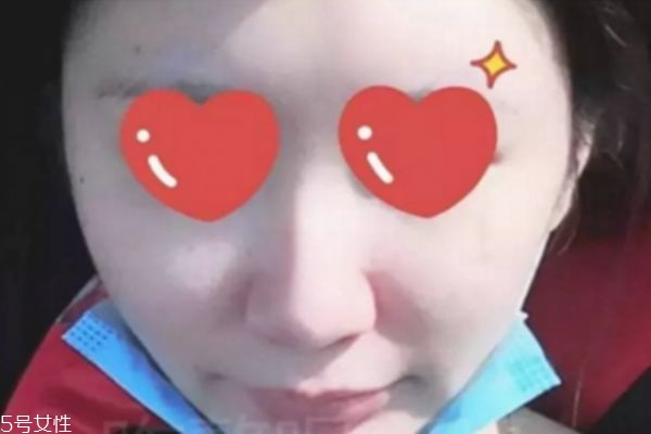 鼻翼內(nèi)切是切鼻基底嗎 鼻翼內(nèi)切效果圖 鼻翼內(nèi)切是切鼻基底嗎 鼻翼內(nèi)切效果圖