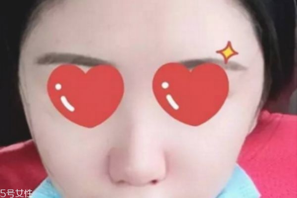 鼻翼內(nèi)切是切鼻基底嗎 鼻翼內(nèi)切效果圖 鼻翼內(nèi)切是切鼻基底嗎 鼻翼內(nèi)切效果圖