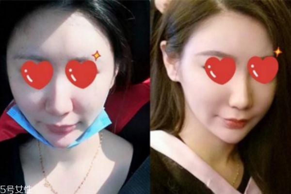 鼻翼內(nèi)切是切鼻基底嗎 鼻翼內(nèi)切效果圖 鼻翼內(nèi)切是切鼻基底嗎 鼻翼內(nèi)切效果圖