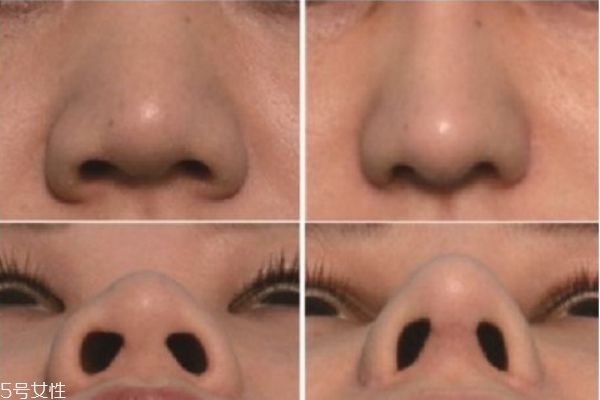 鼻翼縮小手術前后對比照片 縮鼻孔手術對比照片 鼻翼縮小手術前后對比照片 縮鼻孔手術對比照片