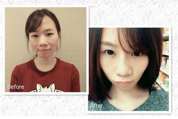 鼻翼縮小手術前后對比照片 縮鼻孔手術對比照片 鼻翼縮小手術前后對比照片 縮鼻孔手術對比照片