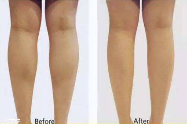 瘦腿針永久嗎 瘦腿針要長期打嗎 瘦腿針永久嗎 瘦腿針要長期打嗎