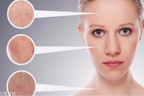 夏天干性皮膚如何護膚 干性皮膚夏天如何補水保濕 夏天干性皮膚如何護膚 干性皮膚夏天如何補水保濕