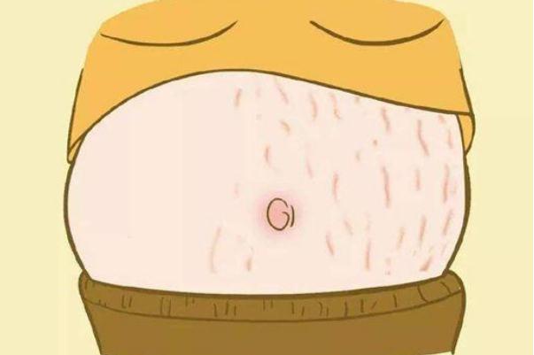 妊娠紋癢可以撓嗎 吃什么預防妊娠紋 妊娠紋癢可以撓嗎 吃什么預防妊娠紋