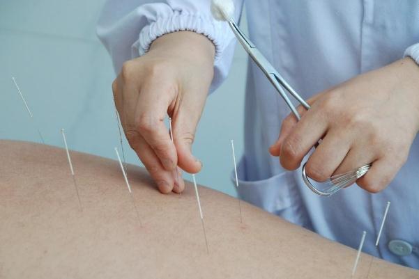 針灸治療失眠效果如何 針灸治療失眠一般多久有明顯效果 針灸治療失眠效果如何 針灸治療失眠一般多久有明顯效果