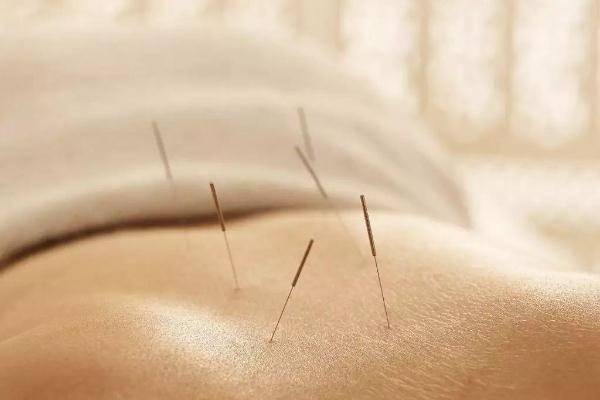 針灸治療失眠效果如何 針灸治療失眠一般多久有明顯效果 針灸治療失眠效果如何 針灸治療失眠一般多久有明顯效果
