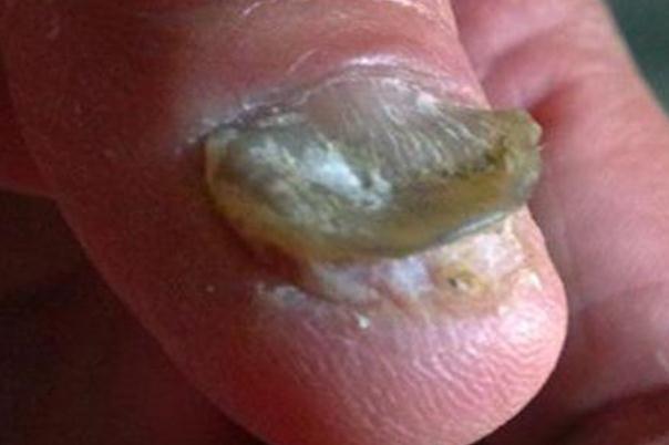 灰指甲有潛伏期嗎 灰指甲有什么癥狀 灰指甲有潛伏期嗎 灰指甲有什么癥狀