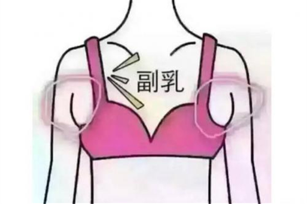 副乳跟胖瘦有關(guān)系嗎 副乳是先天性的嗎 副乳跟胖瘦有關(guān)系嗎 副乳是先天性的嗎