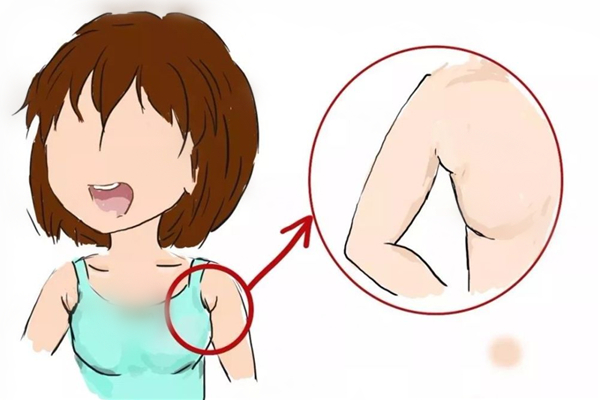 副乳跟胖瘦有關(guān)系嗎 副乳是先天性的嗎 副乳跟胖瘦有關(guān)系嗎 副乳是先天性的嗎