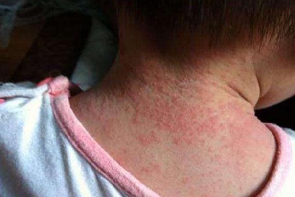 寶寶長(zhǎng)痱子可以吃蝦嗎 寶寶長(zhǎng)痱子可以打疫苗嗎 寶寶長(zhǎng)痱子可以吃蝦嗎 寶寶長(zhǎng)痱子可以打疫苗嗎