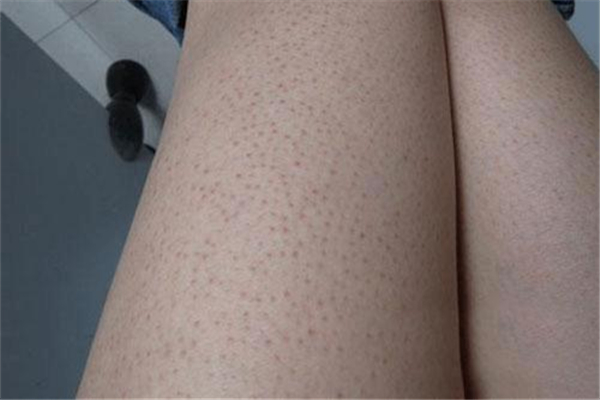 雞皮膚對健康有影響嗎 雞皮膚有什么危害 雞皮膚對健康有影響嗎 雞皮膚有什么危害