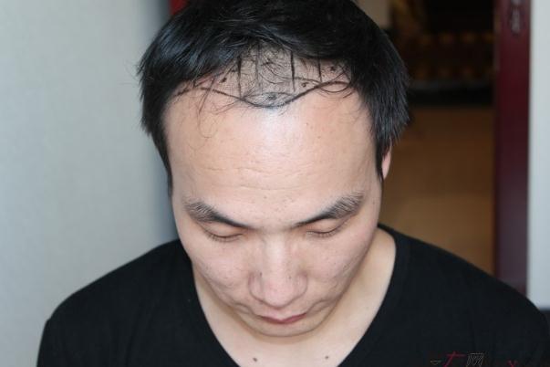 植發(fā)對身體健康有影響嗎 植發(fā)對頭皮有傷害嗎 植發(fā)對身體健康有影響嗎 植發(fā)對頭皮有傷害嗎