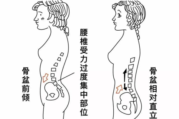 骨盆前傾能矯正過(guò)來(lái)嗎 骨盆前傾最快糾正法