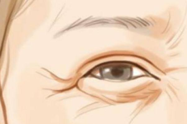 魚(yú)尾紋除皺針打一次能保持多久 魚(yú)尾紋除皺針有什么副作用 魚(yú)尾紋除皺針打一次能保持多久 魚(yú)尾紋除皺針有什么副作用