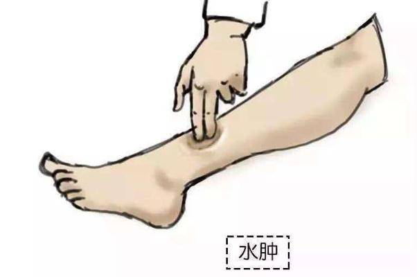 水腫是什么意思 過敏性水腫癥狀有哪些 水腫是什么意思 過敏性水腫癥狀有哪些