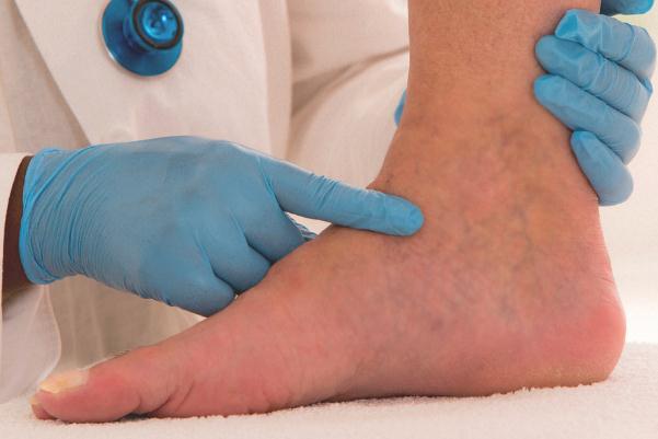 水腫是什么意思 過敏性水腫癥狀有哪些 水腫是什么意思 過敏性水腫癥狀有哪些