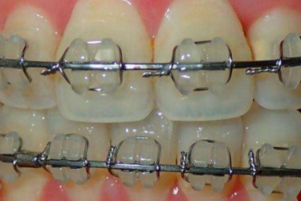 牙套的壽命是多少年 牙套的原理 牙套的壽命是多少年 牙套的原理